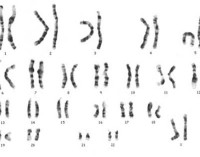 Endocrinologia: sindrome di Klinefelter