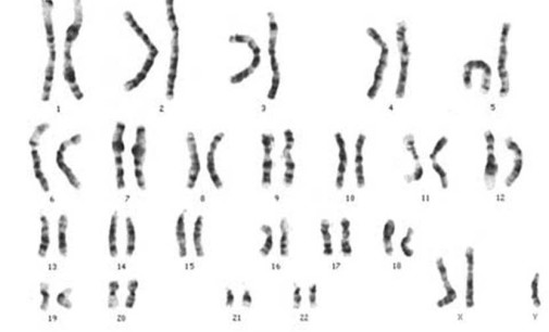 Endocrinologia: sindrome di Klinefelter